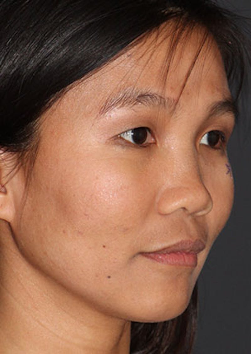 Rhinoplasty Before & After Gallery - Patient 106569196 - Image 3