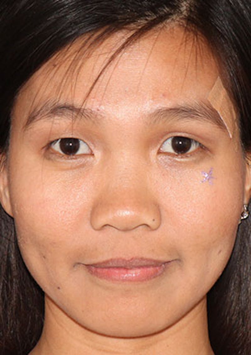Rhinoplasty Before & After Gallery - Patient 106569196 - Image 5