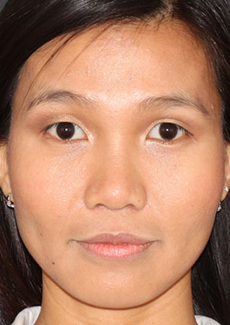Rhinoplasty Before & After Gallery - Patient 106569196 - Image 6