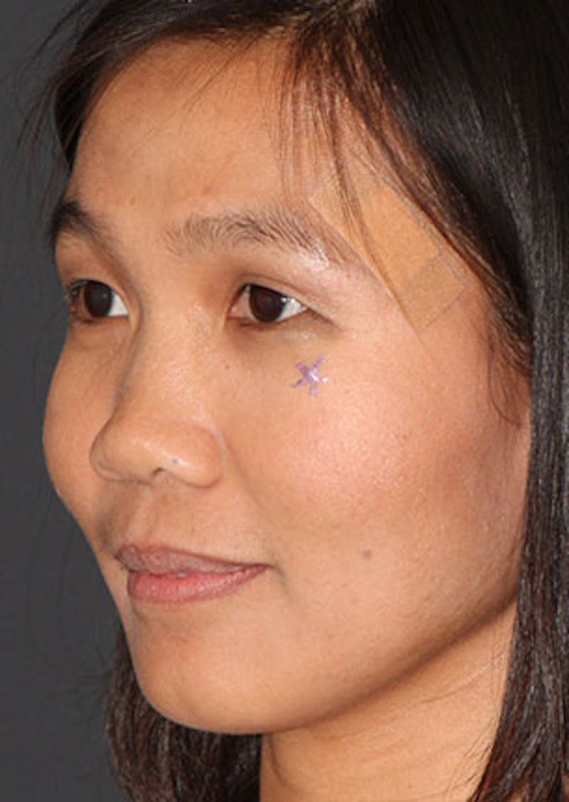 Rhinoplasty Before & After Gallery - Patient 106569196 - Image 7