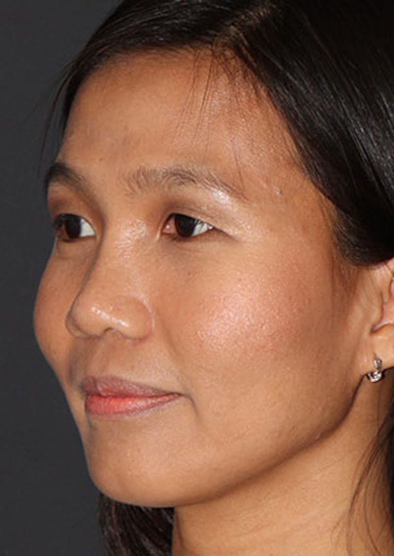 Rhinoplasty Before & After Gallery - Patient 106569196 - Image 8