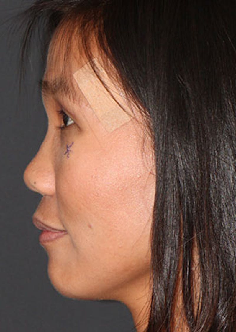 Rhinoplasty Before & After Gallery - Patient 106569196 - Image 9