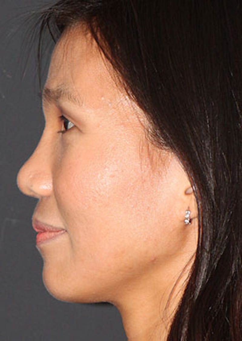 Rhinoplasty Before & After Gallery - Patient 106569196 - Image 10