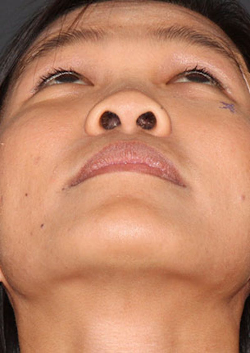 Rhinoplasty Before & After Gallery - Patient 106569196 - Image 11