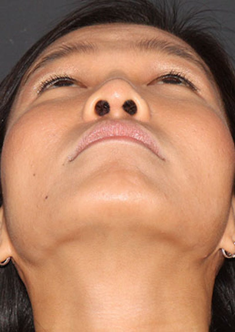 Rhinoplasty Before & After Gallery - Patient 106569196 - Image 12