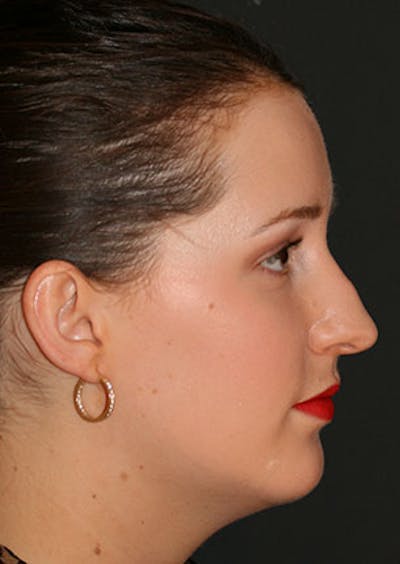 Rhinoplasty Before & After Gallery - Patient 106569199 - Image 1