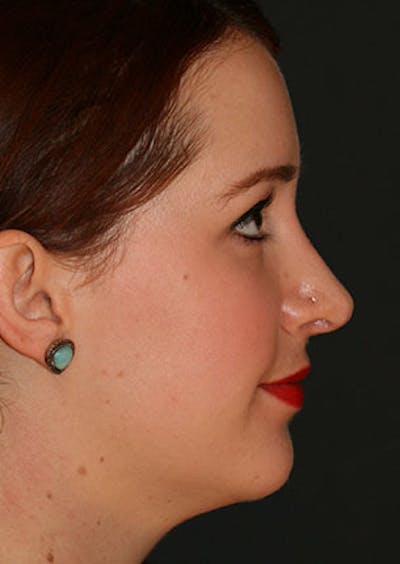 Rhinoplasty Before & After Gallery - Patient 106569199 - Image 2