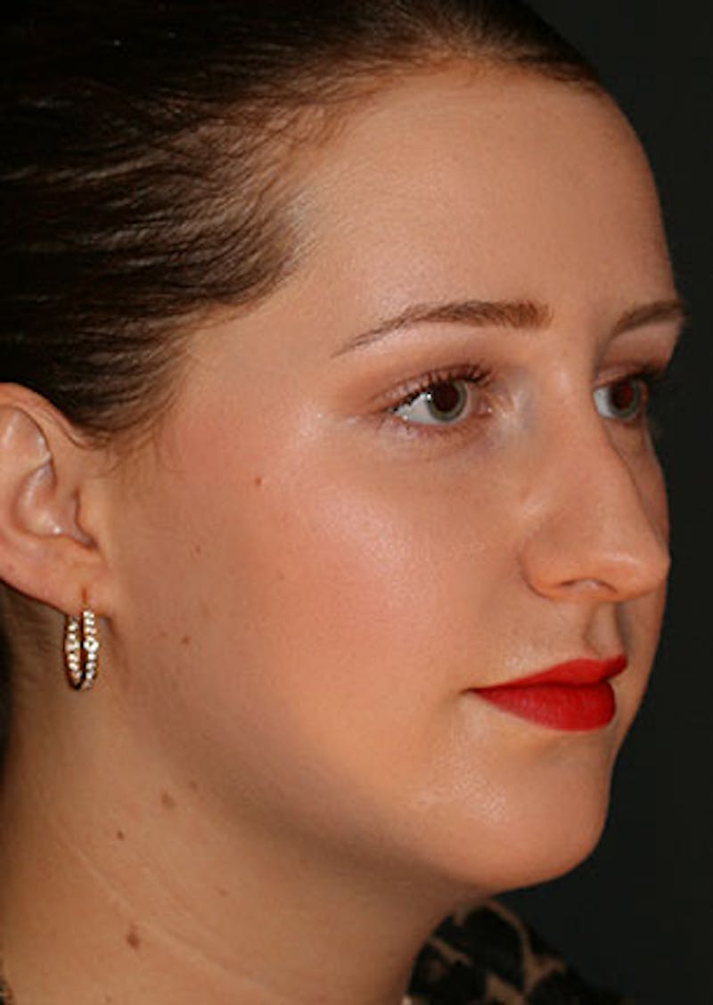 Rhinoplasty Before & After Gallery - Patient 106569199 - Image 3