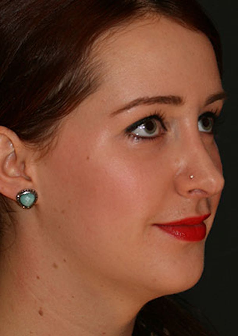 Rhinoplasty Before & After Gallery - Patient 106569199 - Image 4