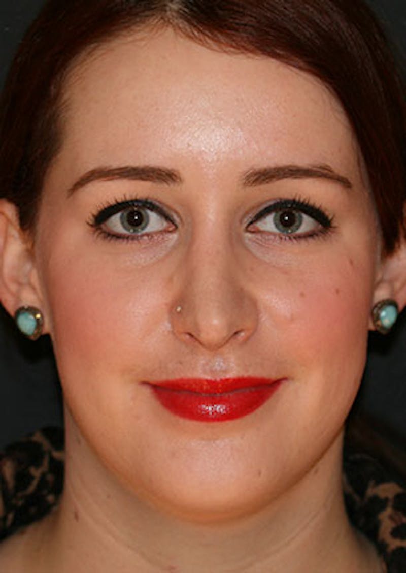 Rhinoplasty Before & After Gallery - Patient 106569199 - Image 6