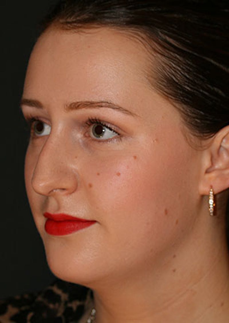 Rhinoplasty Before & After Gallery - Patient 106569199 - Image 7