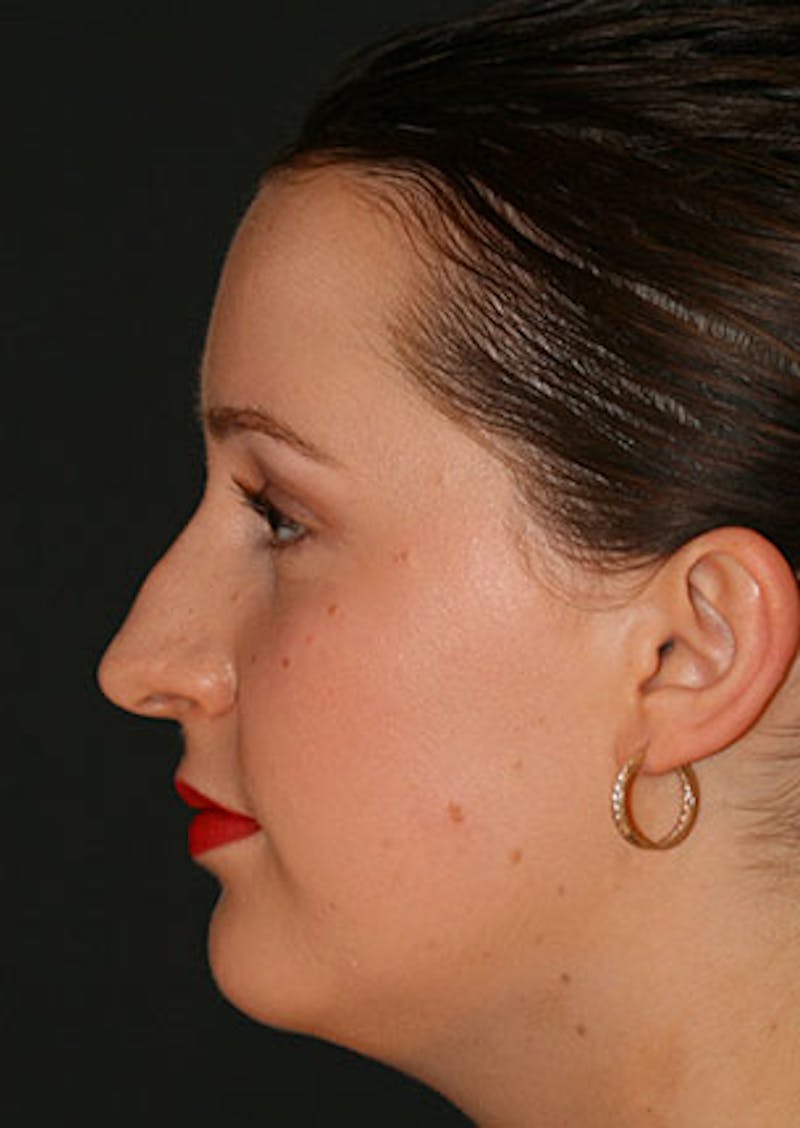 Rhinoplasty Before & After Gallery - Patient 106569199 - Image 9