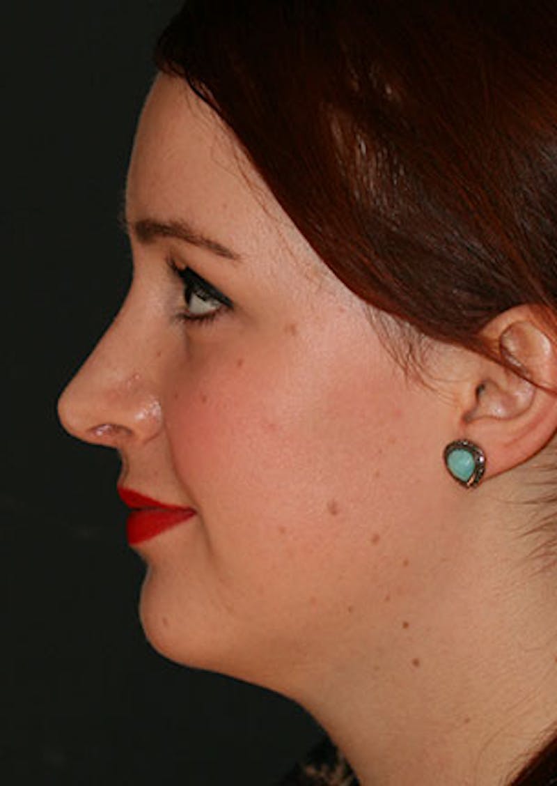 Rhinoplasty Before & After Gallery - Patient 106569199 - Image 10
