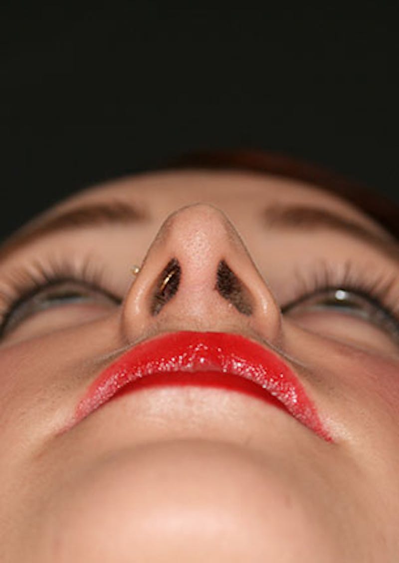 Rhinoplasty Before & After Gallery - Patient 106569199 - Image 12