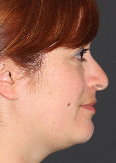 Rhinoplasty Before & After Gallery - Patient 106569218 - Image 1