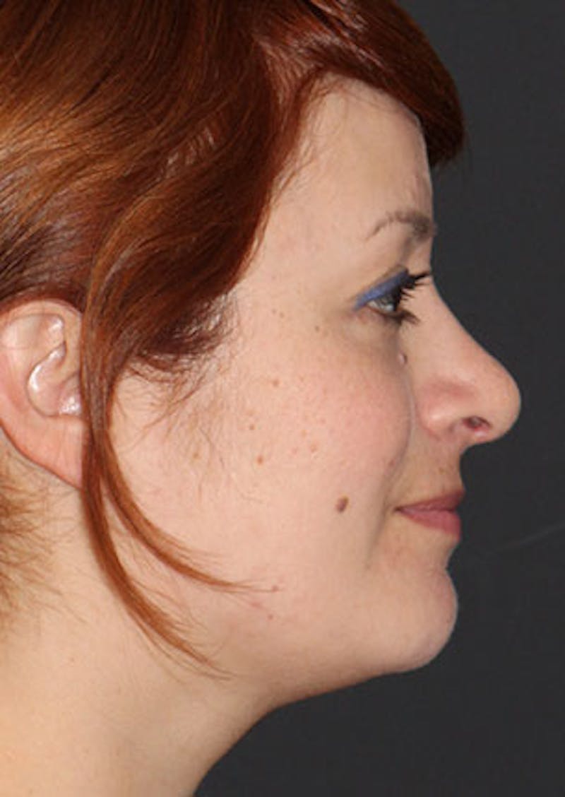 Rhinoplasty Before & After Gallery - Patient 106569218 - Image 2