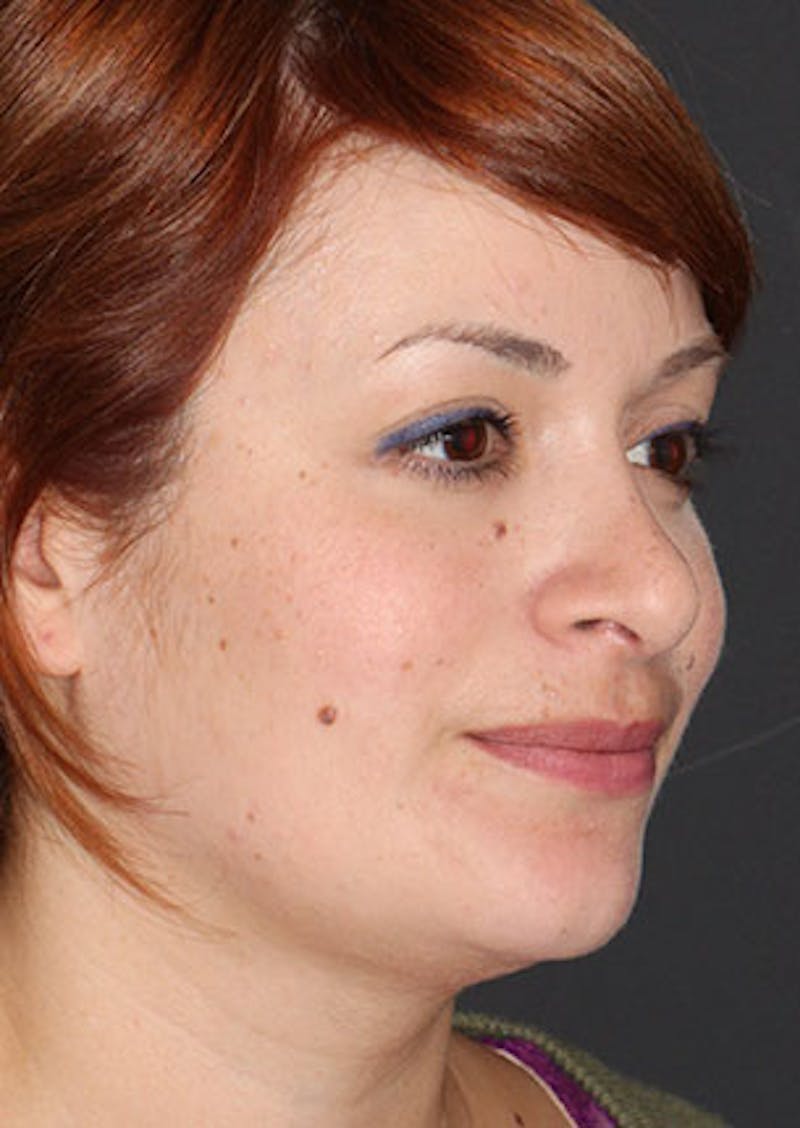 Rhinoplasty Before & After Gallery - Patient 106569218 - Image 4