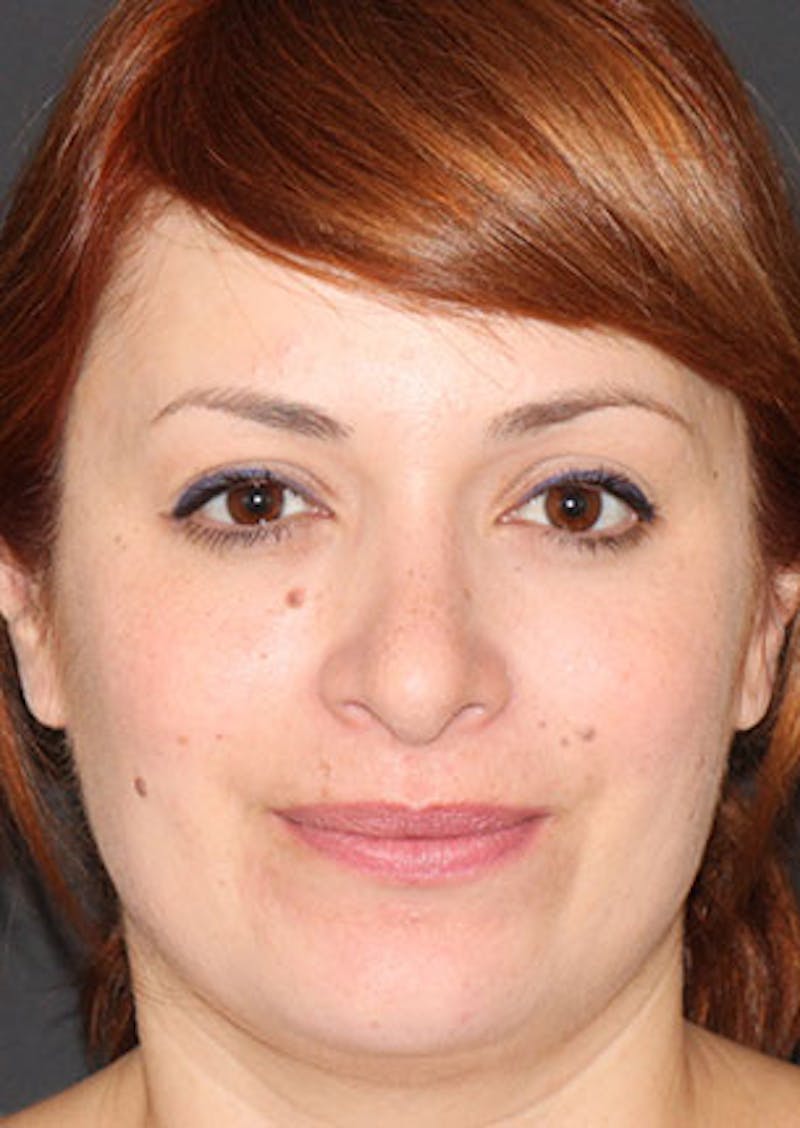 Rhinoplasty Before & After Gallery - Patient 106569218 - Image 6