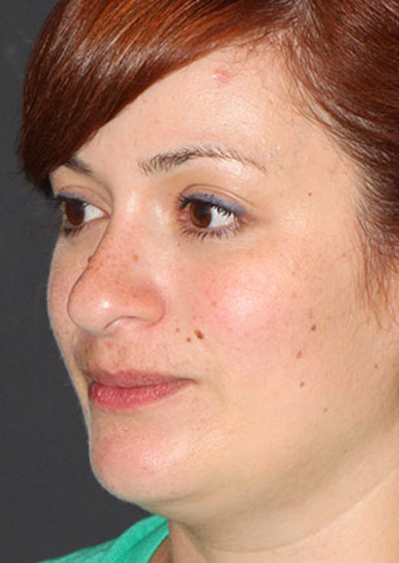 Rhinoplasty Before & After Gallery - Patient 106569218 - Image 7