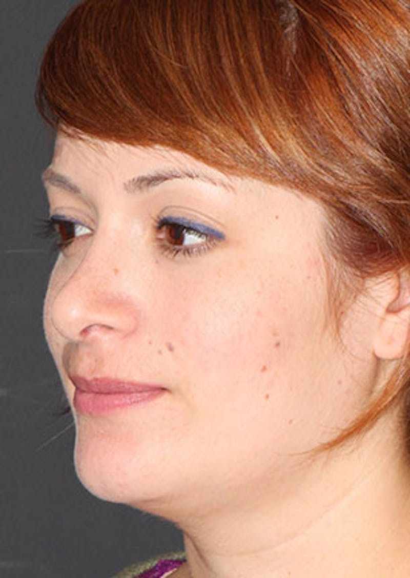 Rhinoplasty Before & After Gallery - Patient 106569218 - Image 8