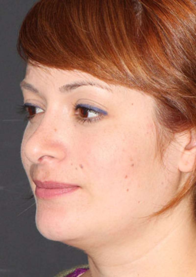 Rhinoplasty Before & After Gallery - Patient 106569218 - Image 8