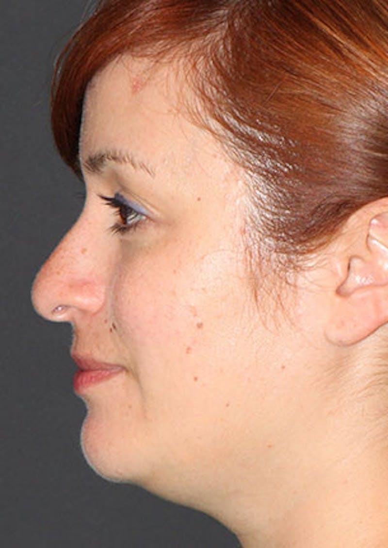Rhinoplasty Before & After Gallery - Patient 106569218 - Image 9