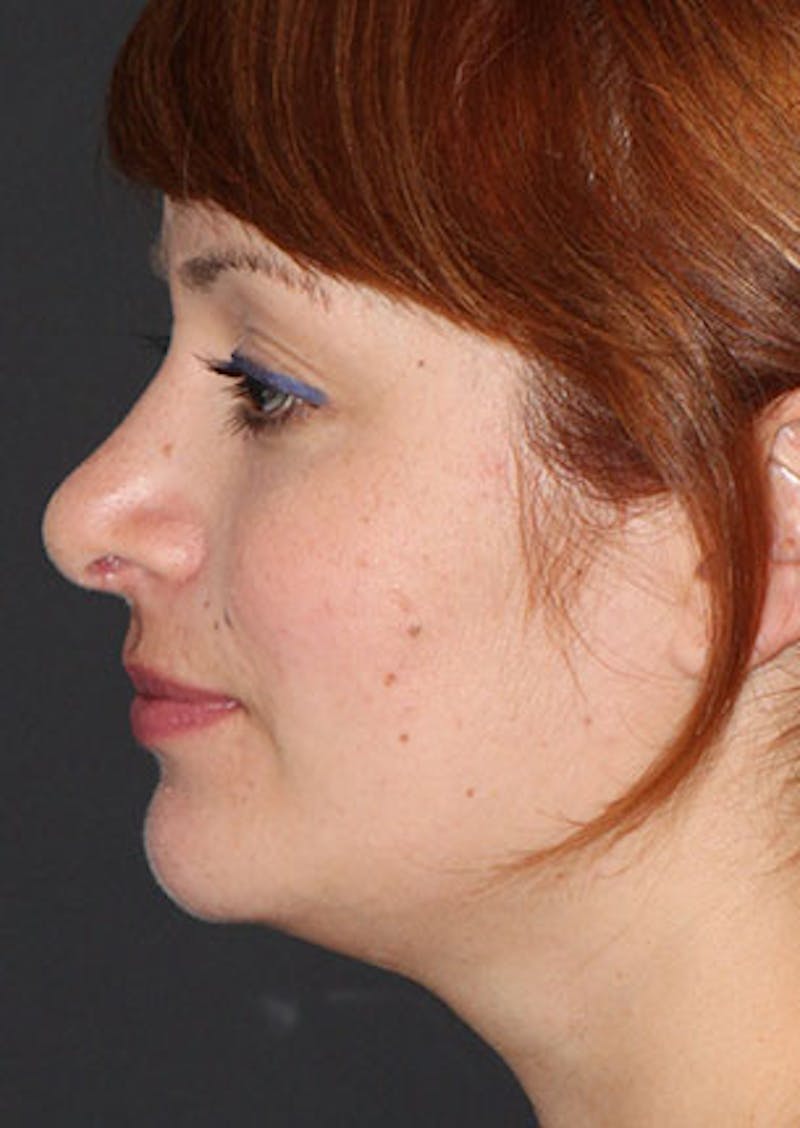 Rhinoplasty Before & After Gallery - Patient 106569218 - Image 10