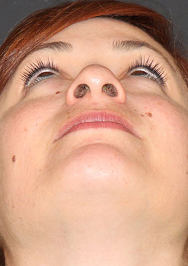 Rhinoplasty Before & After Gallery - Patient 106569218 - Image 11