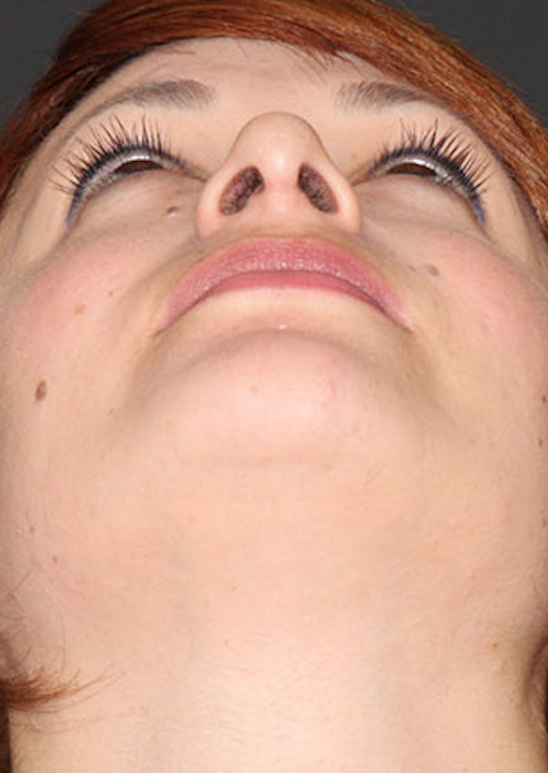 Rhinoplasty Before & After Gallery - Patient 106569218 - Image 12