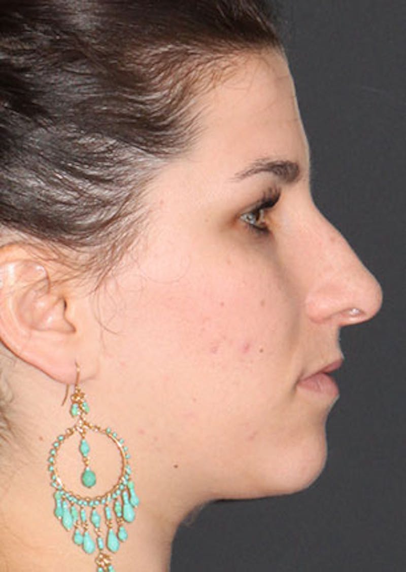 Rhinoplasty Before & After Gallery - Patient 106569224 - Image 1