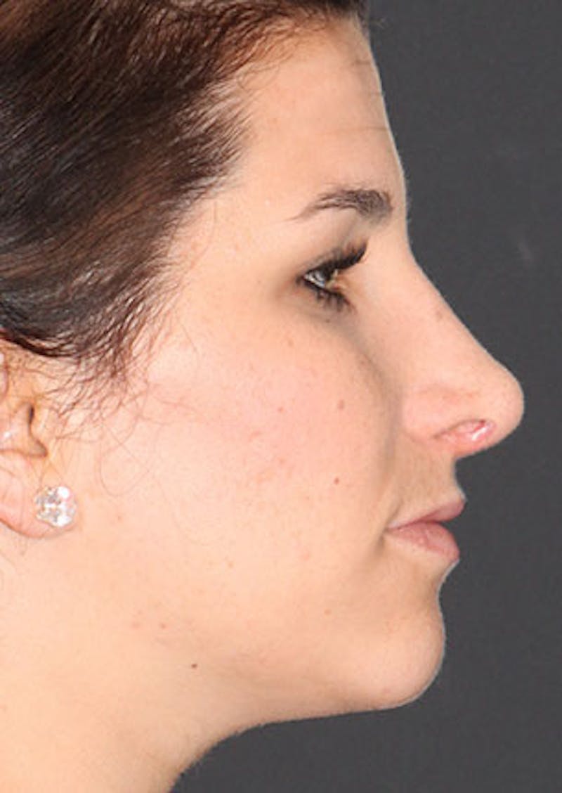 Rhinoplasty Before & After Gallery - Patient 106569224 - Image 2