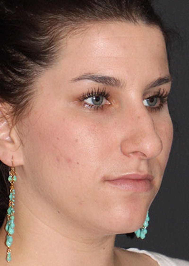 Rhinoplasty Before & After Gallery - Patient 106569224 - Image 3