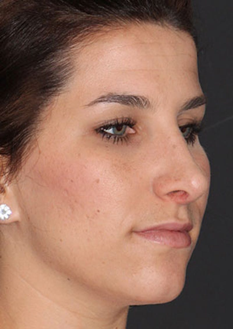 Rhinoplasty Before & After Gallery - Patient 106569224 - Image 4