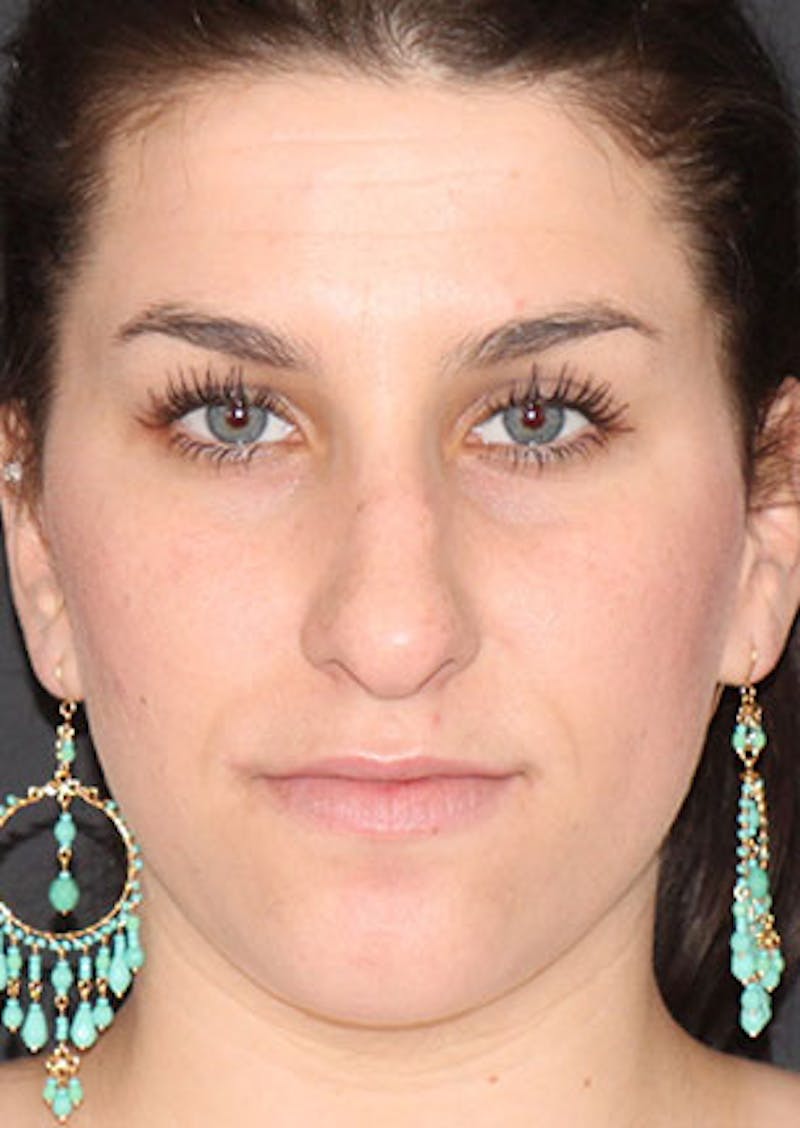 Rhinoplasty Before & After Gallery - Patient 106569224 - Image 5