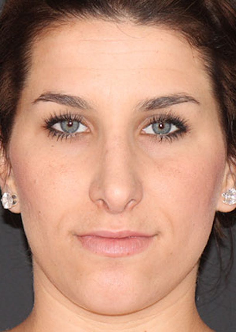 Rhinoplasty Before & After Gallery - Patient 106569224 - Image 6
