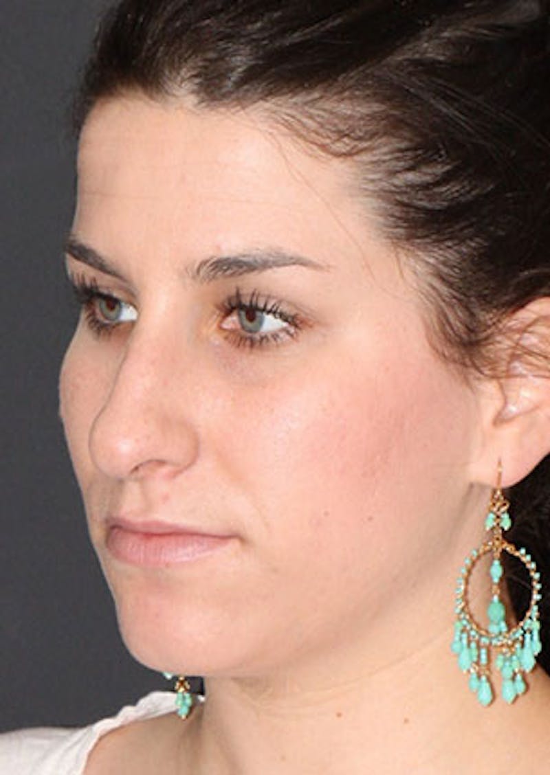 Rhinoplasty Before & After Gallery - Patient 106569224 - Image 7