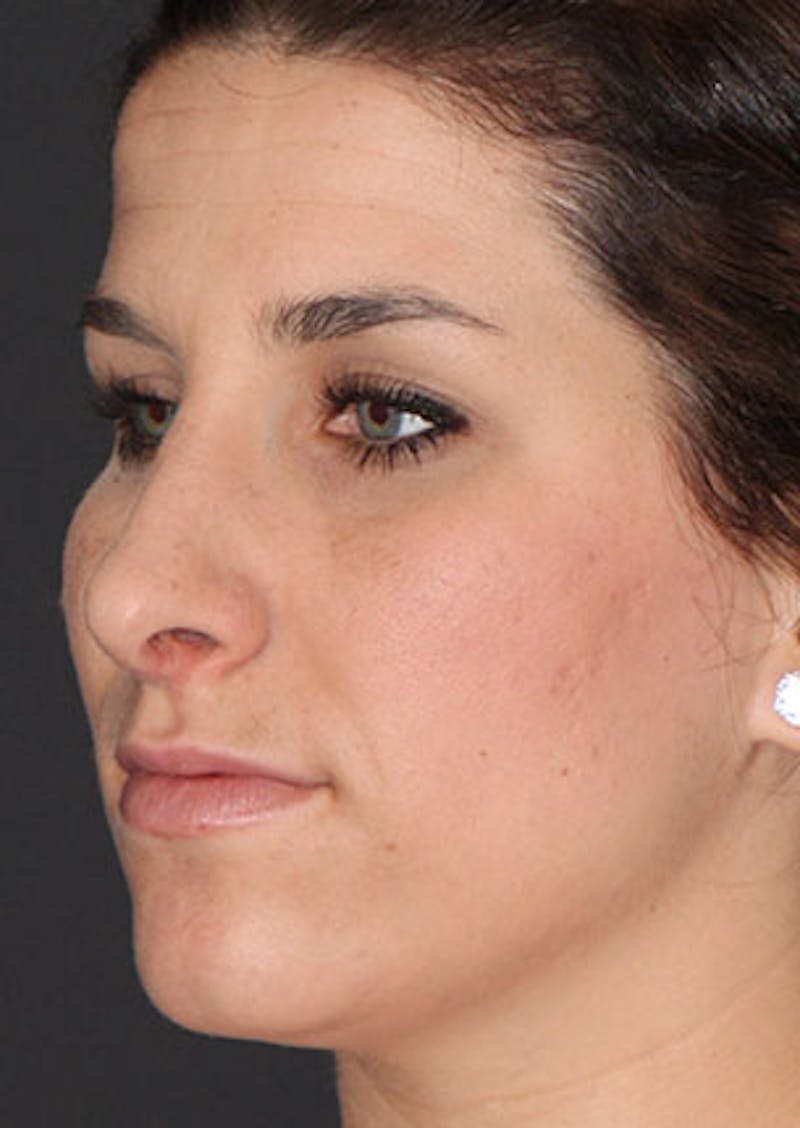 Rhinoplasty Before & After Gallery - Patient 106569224 - Image 8