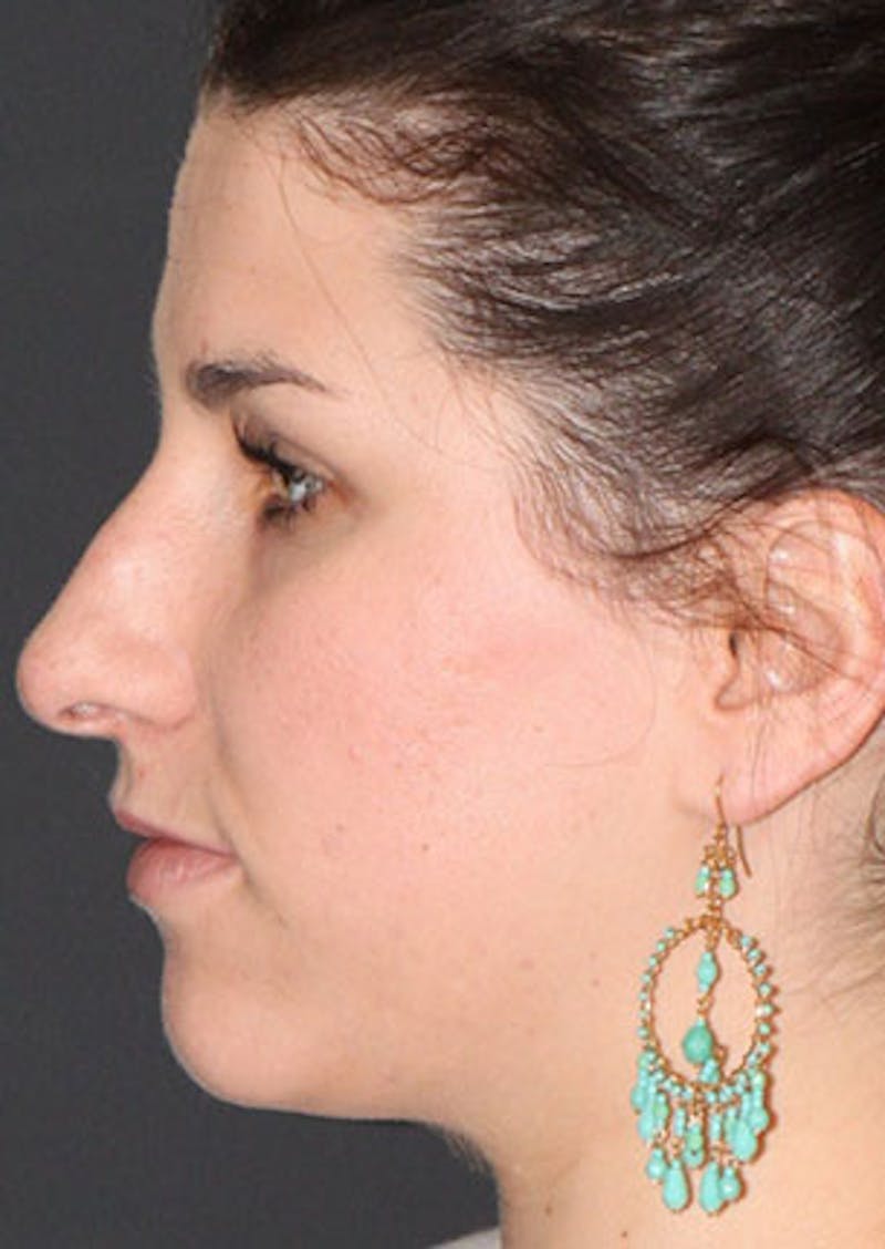 Rhinoplasty Before & After Gallery - Patient 106569224 - Image 9