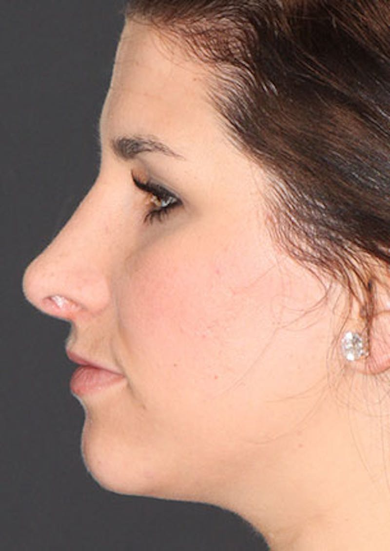 Rhinoplasty Before & After Gallery - Patient 106569224 - Image 10