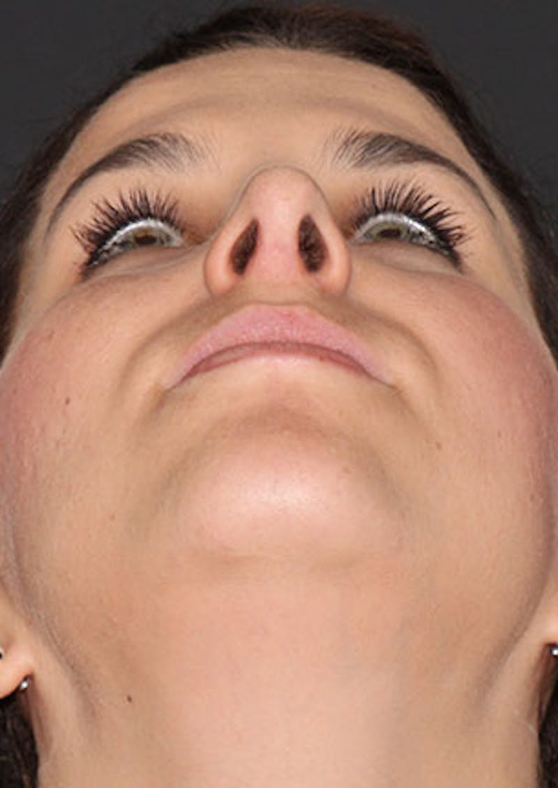 Rhinoplasty Before & After Gallery - Patient 106569224 - Image 12