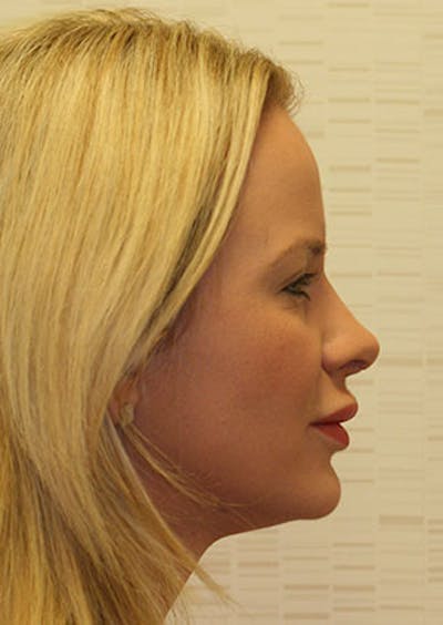 Rhinoplasty Before & After Gallery - Patient 106569292 - Image 2