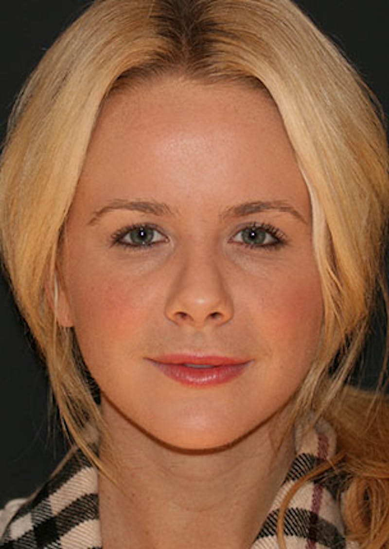 Rhinoplasty Before & After Gallery - Patient 106569292 - Image 5