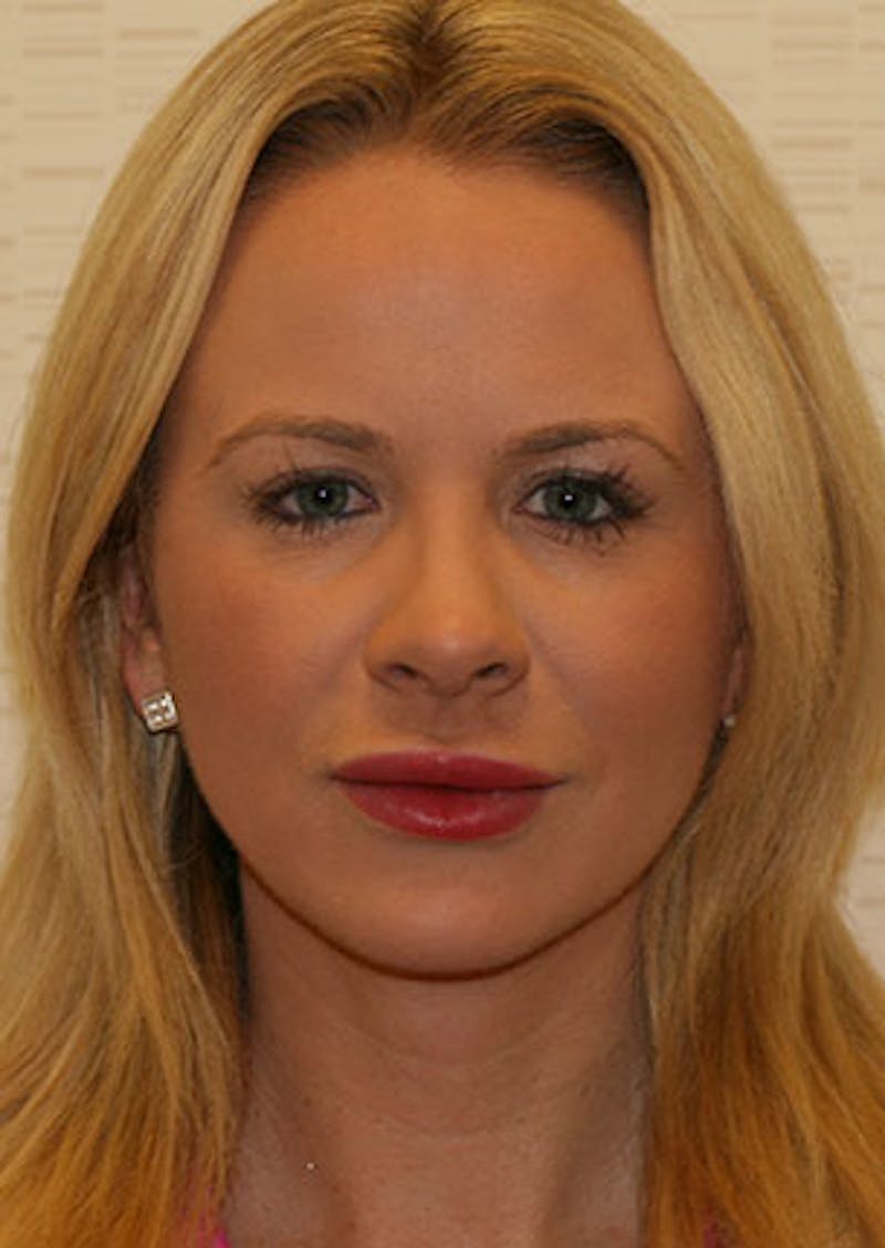 Rhinoplasty Before & After Gallery - Patient 106569292 - Image 6