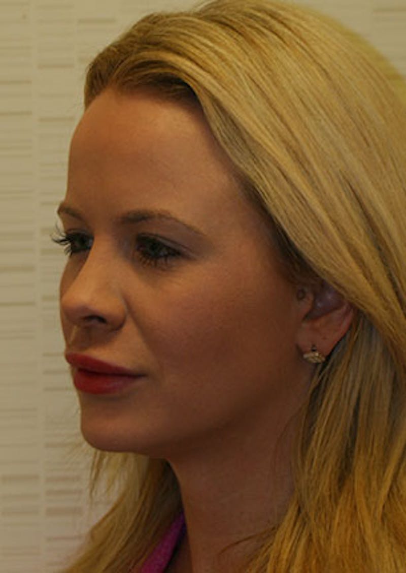 Rhinoplasty Before & After Gallery - Patient 106569292 - Image 8
