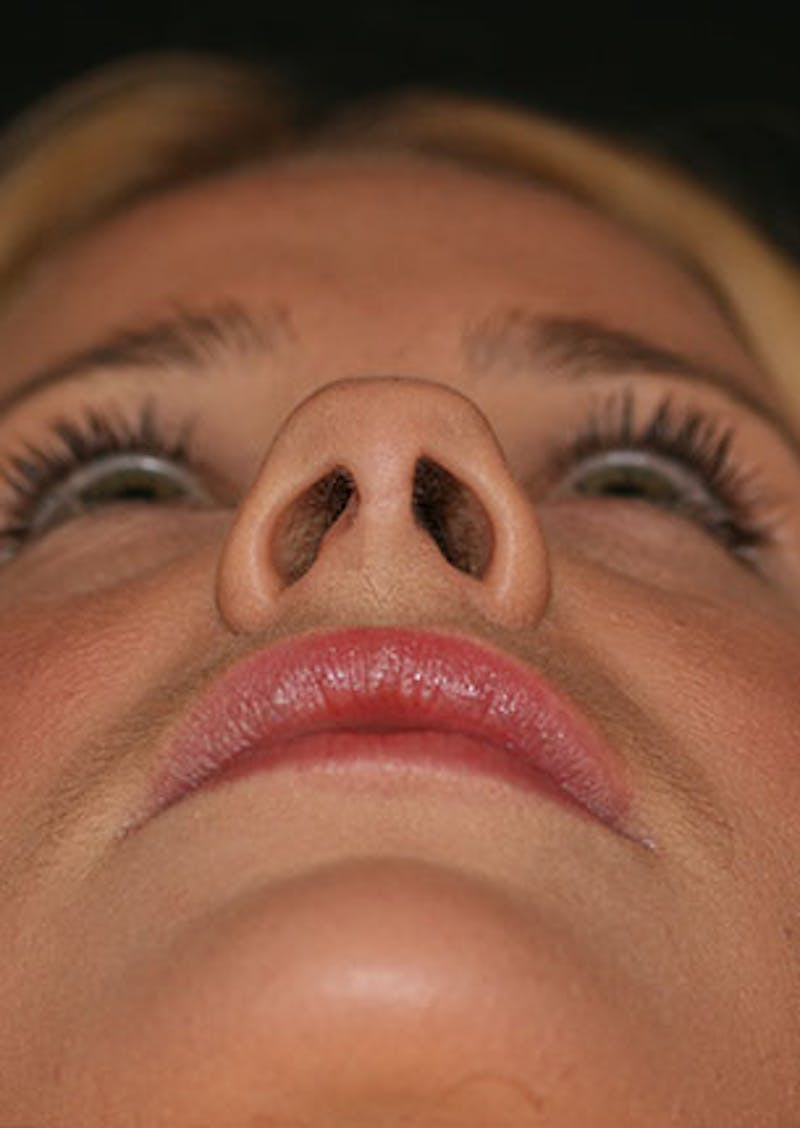 Rhinoplasty Before & After Gallery - Patient 106569292 - Image 11