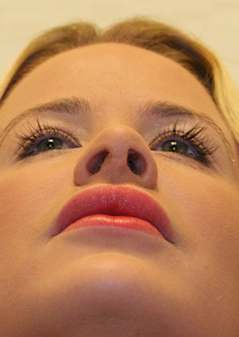Rhinoplasty Before & After Gallery - Patient 106569292 - Image 12
