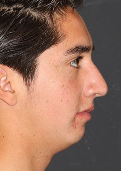 Rhinoplasty Before & After Gallery - Patient 106569294 - Image 1