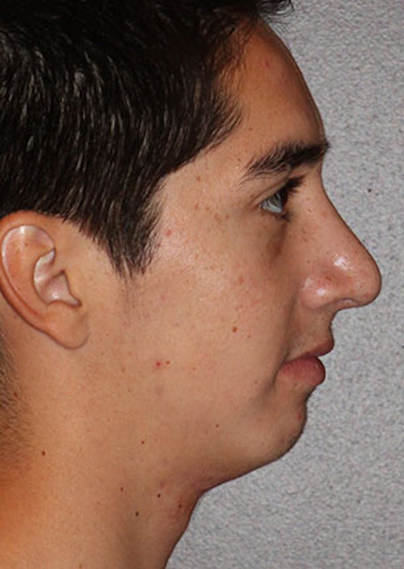 Rhinoplasty Before & After Gallery - Patient 106569294 - Image 2