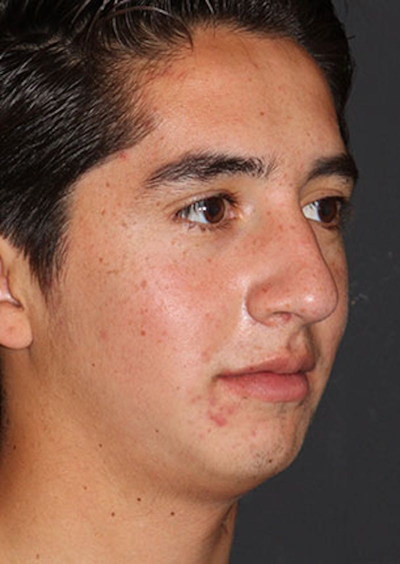 Rhinoplasty Before & After Gallery - Patient 106569294 - Image 3