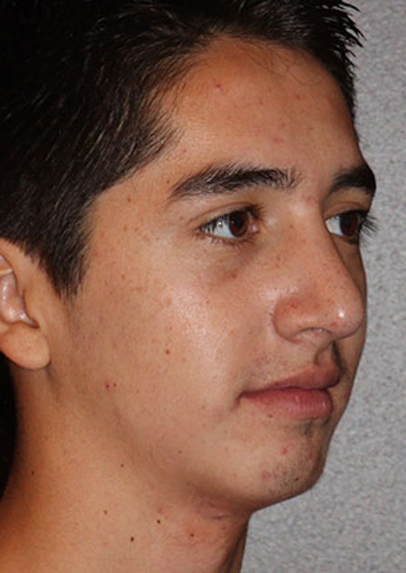 Rhinoplasty Before & After Gallery - Patient 106569294 - Image 4